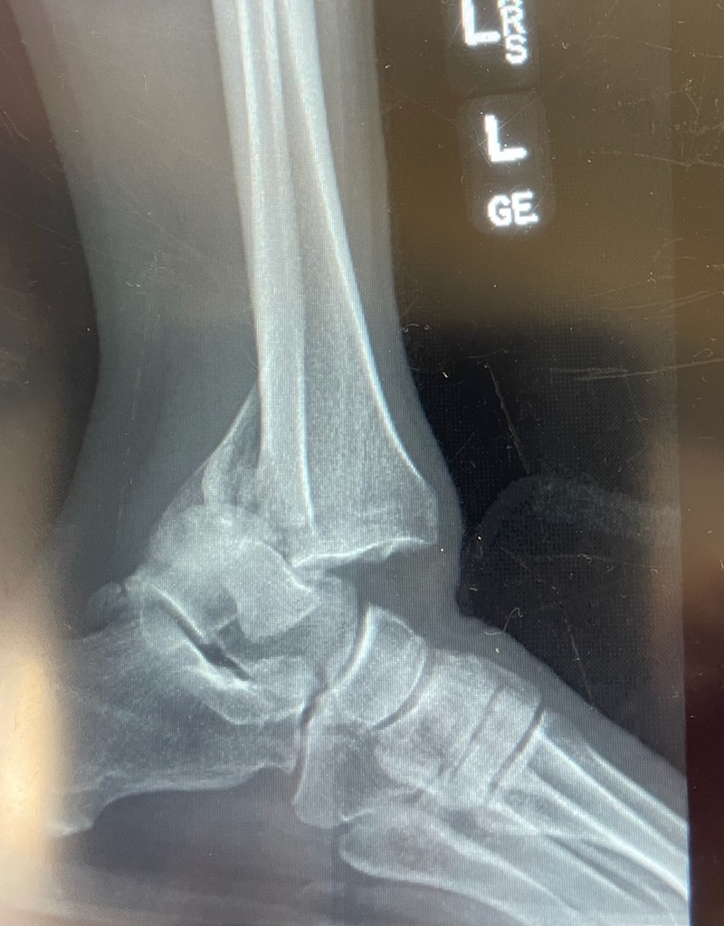 broken ankle before reduction