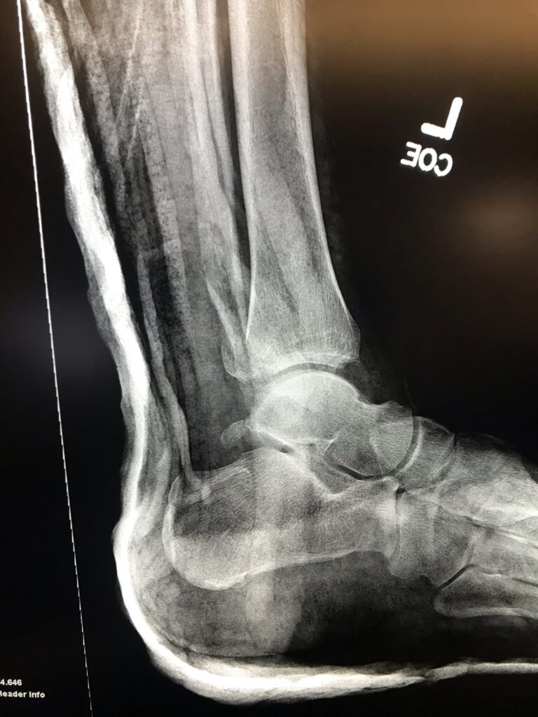 Broken ankle after reduction