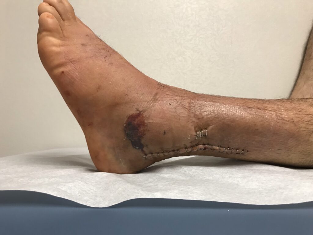 lateral ankle wound