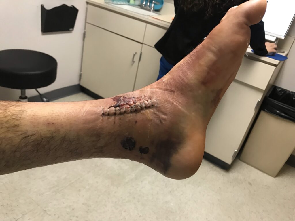 Medial Ankle wound