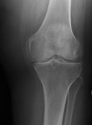 User Question #2: Osteoarthritis