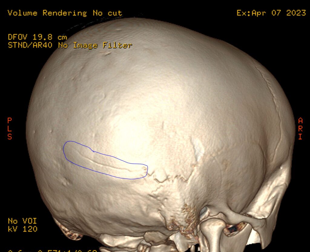 injury fracture